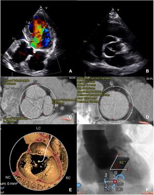 Case Report of snare-assisted coaxiality optimized technique during valve deployment in patient with pure aortic regurgitation